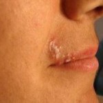 Lips Injuries