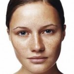Home Remedies for Dark Spots