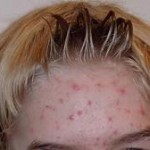 acne care