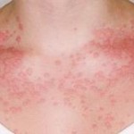 Food Allergy Skin Rash
