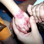 Epidermolysis bullosa