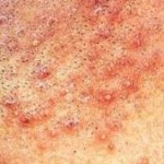 folliculitis