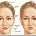 remove wrinkles 