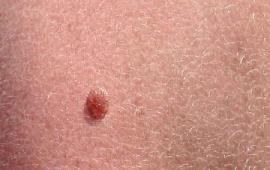 Wart - Wikipedia