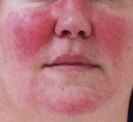 Rosacea 