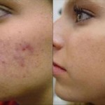 Treatments of acne