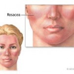 Rosacea