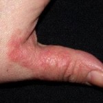 eczema 