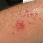 Skin Infections