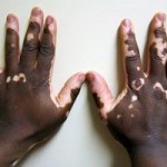 What is vitiligo